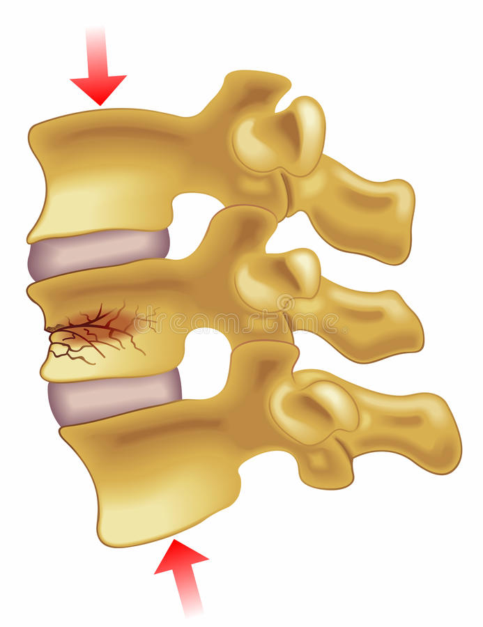 fracture-par-compression-vertébrale-68077052.jpg